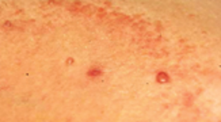 Eczema around molluscum contagiosum image