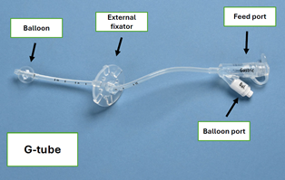 Image of a G-tube for enteral feeding