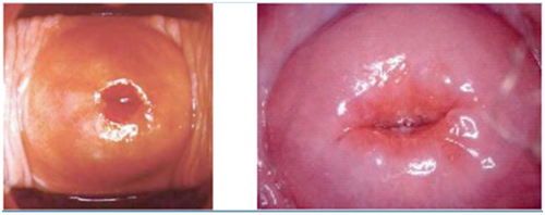 Normal Cervix